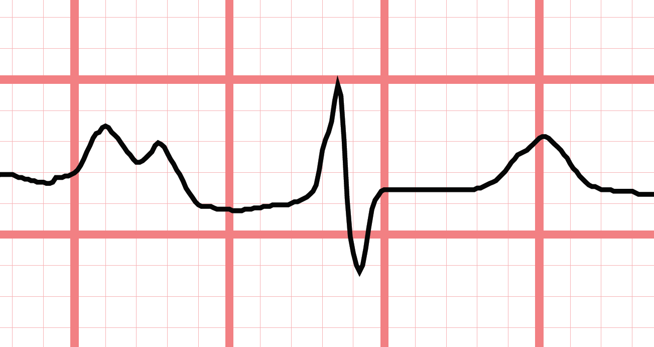 Here are 2 examples of M shaped P waves in lead II